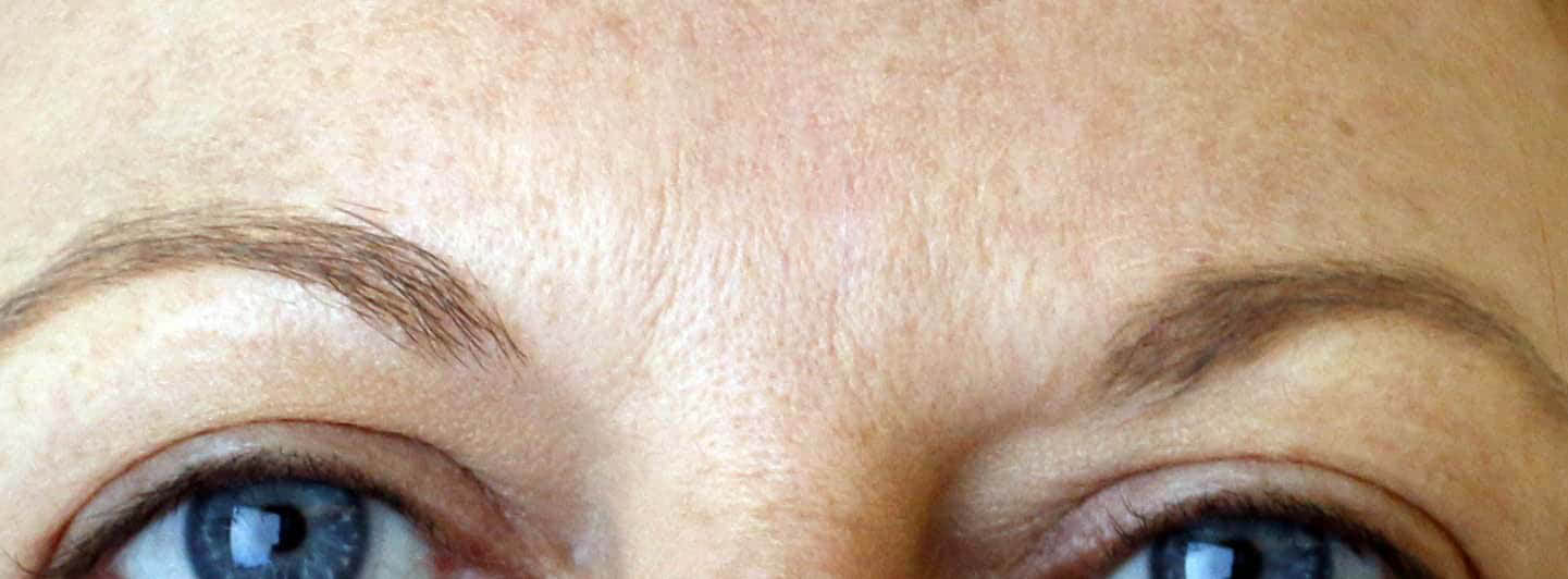 injection acide hyaluronique levres avant apres docteur sar lille villeneuve d'ascq face